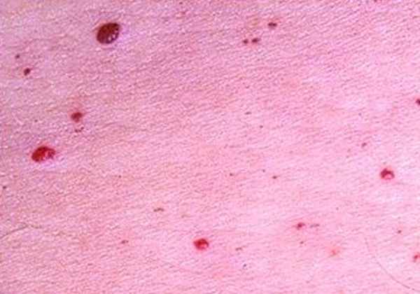 Cherry Angioma - Pictures, Removal, Causes, Home Treatment