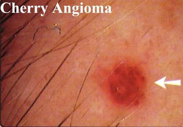 Cherry Angioma photos