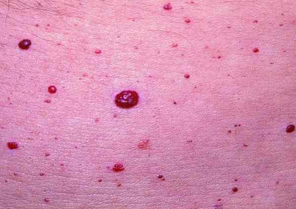 cherry angioma removal face treatment causes