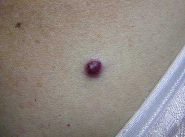 Cherry Angioma pictures