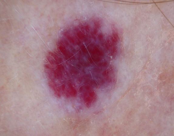 Cherry Angioma Pictures Removal Causes Home Treatment   Cherry Angioma 