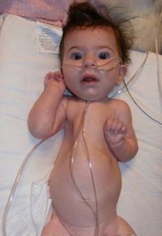 Spinal Muscular Atrophy images