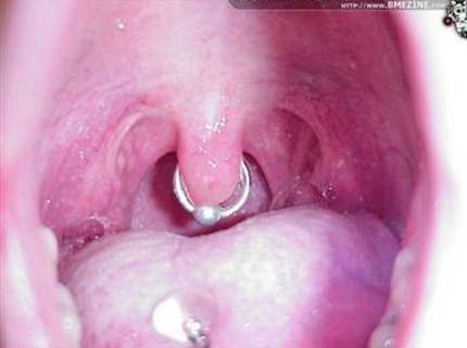Swollen Uvula (enlarged uvula) Pictures