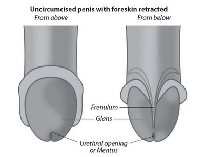 Tight Foreskin diagram
