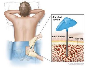 bone marrow aspiration