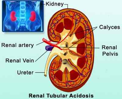 renal tubular acidosis