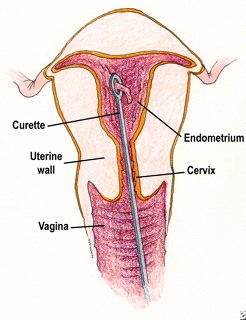 dilatation and curettage