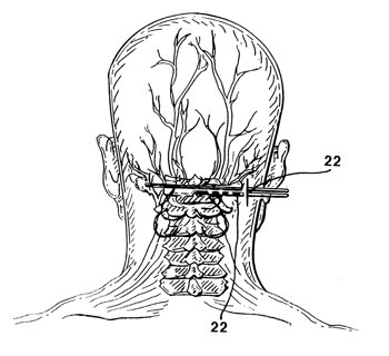 Peripheral Nerve Stimulation Image