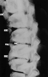 X ray of spondyloarthopathy