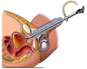Transurethal Resecton of the Prostate Image