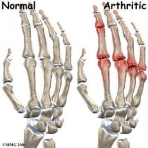 Degenerative Arthritis - Treatment, Symptoms, Causes, Types