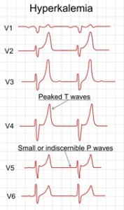 Hyperkalemia - Symptoms, Treatment, What Is?, Causes