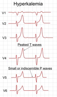 hyperkalemia ECG Image