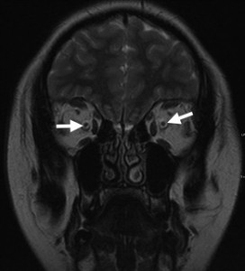 Pseudotumor Cerebri - Treatment, Symptoms, Causes, Diagnosis, MRI