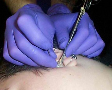 Helix piercing procedure