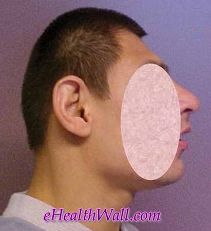 Microcephaly (small head) pictures