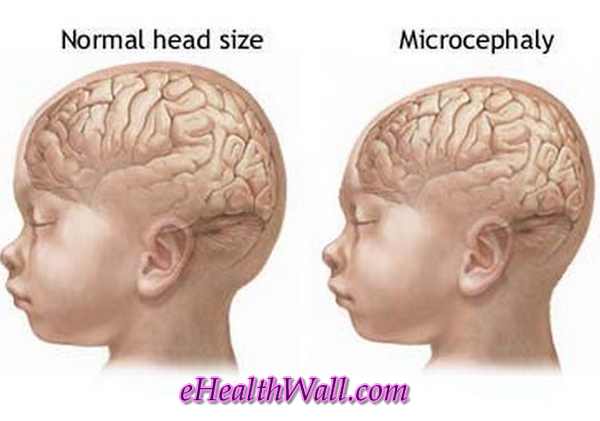 Microcephaly with normal head comparison