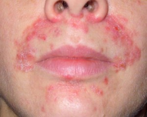 Perioral Dermatitis - Children, Treatment, Symptoms, Causes, And Diet