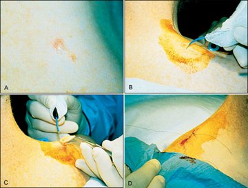 Biopsy Image