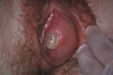 bartholin cyst image