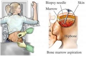 bone marrow biopsy