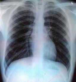 chest congestion x ray