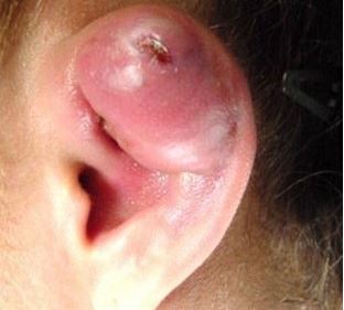 ear cartilage piercing infection