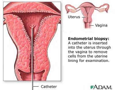 endometrial biopsy for bleeding after menopause