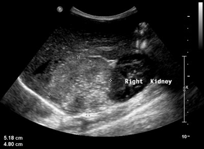 ultrasound of kidney image