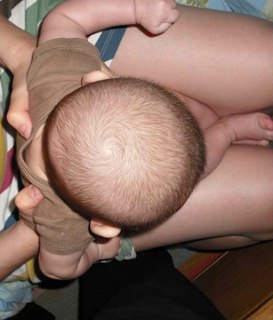 Positional Plagiocephaly Image