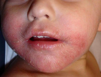Perioral Dermatitis in Children Image