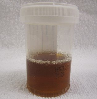 tea colored urine image