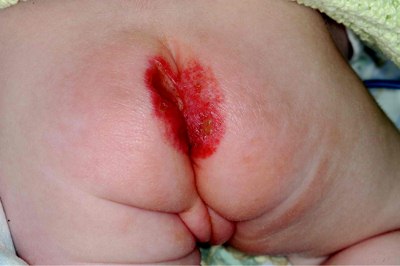 ulceration of anus image