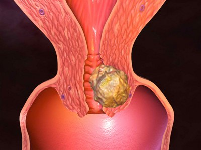 Uterine Cancer 