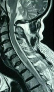 Acute Disseminated Encephalomyelitis pics