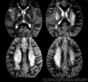 Pictures of Acute Disseminated Encephalomyelitis