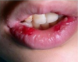 Bleeding Herpetic Gingivostomatitis images