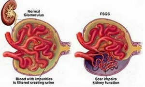 Focal Segmental Glomerulosclerosis pics
