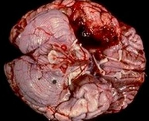 Herpes Encephalitis Pic