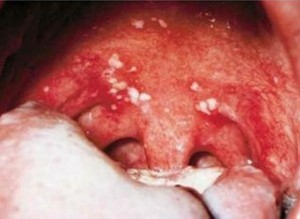 Pictures of Herpetic Gingivostomatitis On the Throat
