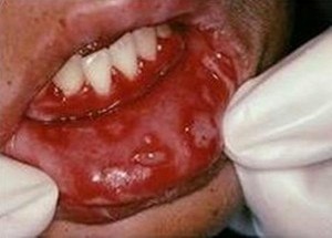 Herpetic Gingivostomatitis on the Lips Pics