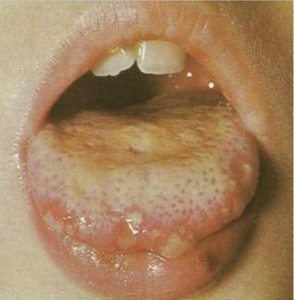 pics of Herpetic Gingivostomatitis on the tongue