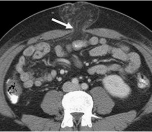 images of Irreducible Hernia