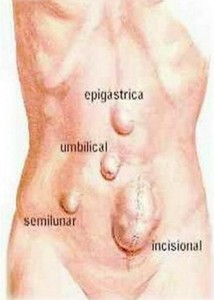 Middle Ventral Hernias pics