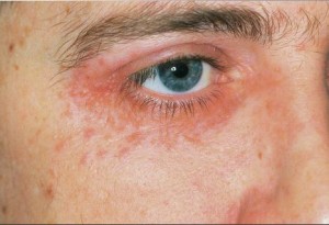 Perioccular Dermatitis pics
