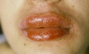 Image of Perioral Dermatitis