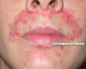 Perioral dermatitis pics