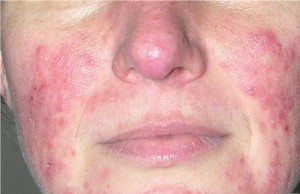 Periorificial dermatitis image