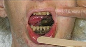 Images of Severe Herpetic Gingivostomatitis