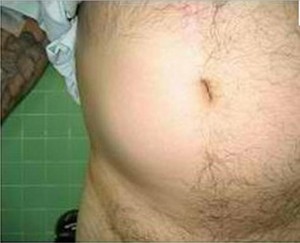 Spigelian Hernia image